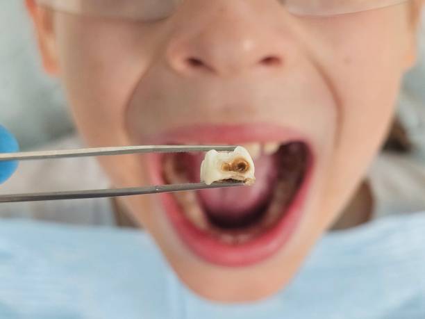 Best Emergency Dentist for Lost Fillings or Crowns in Mcgregor, TX